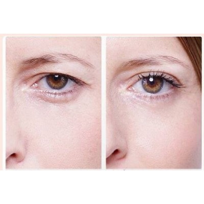 Αυτοκόλλητο Ανόρθωσης Βλεφάρου Eyelid Lift Strips 810 Τεμάχια