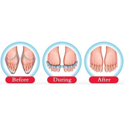2 x Ορθοπεδικά Διαχωριστικά Gel Μασάζ Δακτύλων Flex-Feet