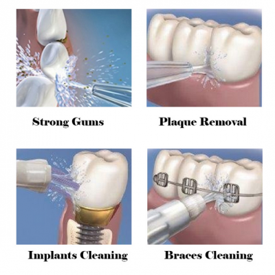 Οδοντιατρικό Σύστημα Καθαρισμού Δοντιών – Waterpulse V300 Dental Flosser Pro